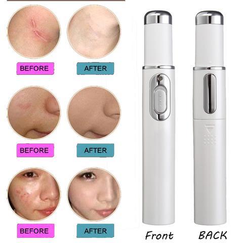 Blue Light Therapy Laser Pen – Acne, Scar & Wrinkle Removal Beauty Device
