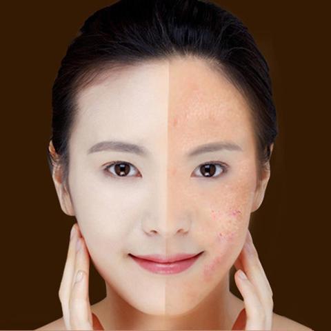 Blue Light Therapy Laser Pen – Acne, Scar & Wrinkle Removal Beauty Device